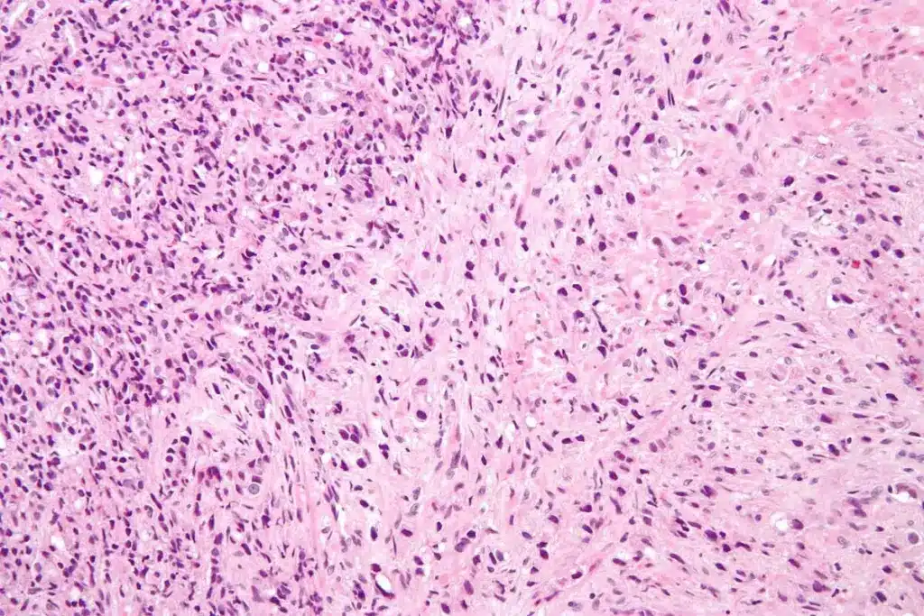 Guide What Is a Prostate Biopsy Painful (Prostate Biopsy Painful)?