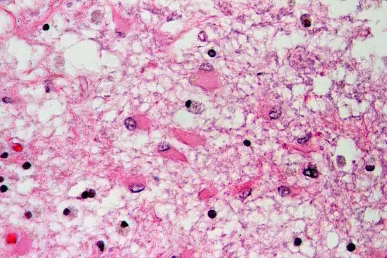 Simple What Is Life Expectancy After Stent?