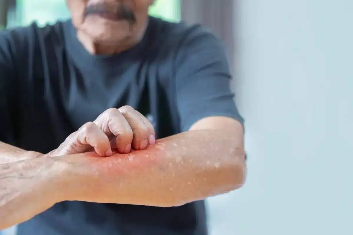 Diseases That Cause Hives In Adults: 50 Crucial Serious Causes List