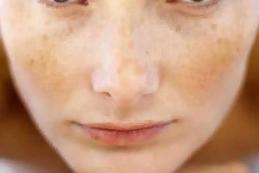 How To Cure Melasma From The Inside: Amazing Powerful Steps