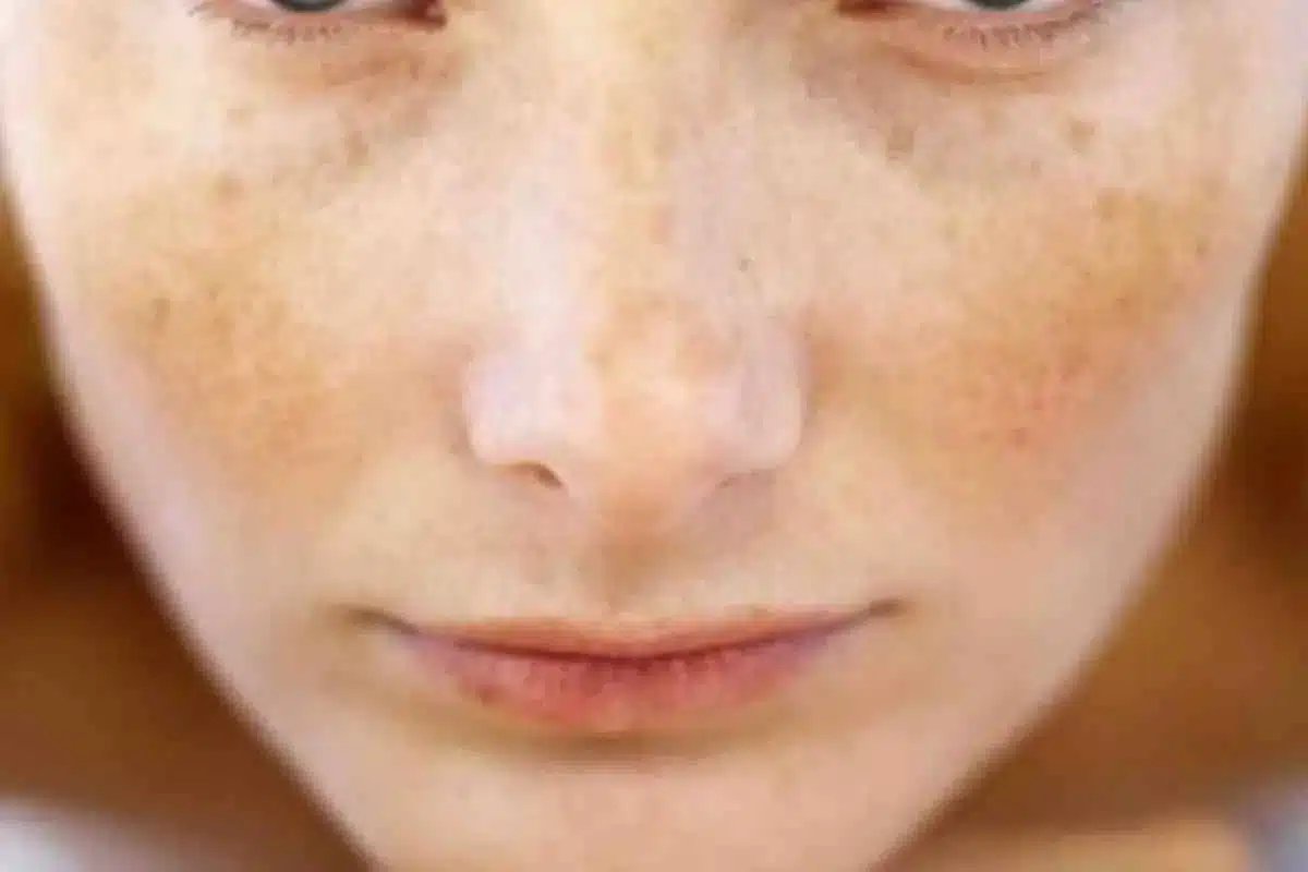 How To Cure Melasma From The Inside: Amazing Powerful Steps