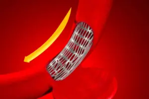 AAA Repair: Amazing Life Expectancy After Endovascular Op