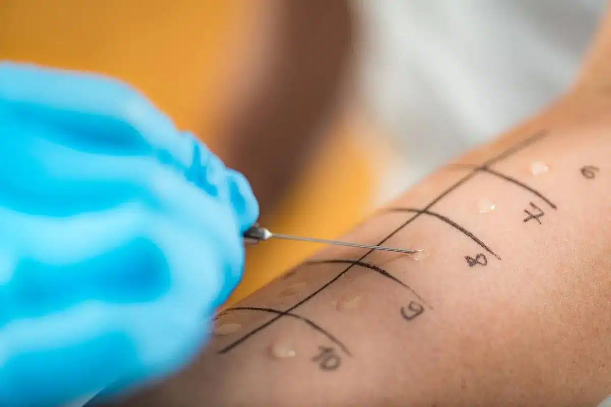 Essential What Is The Most Accurate Allergy Testing For Allergic Reactions?