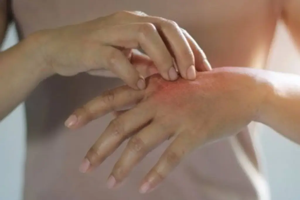 Signs Of Eczema: Crucial Positive Healing Signs Fact