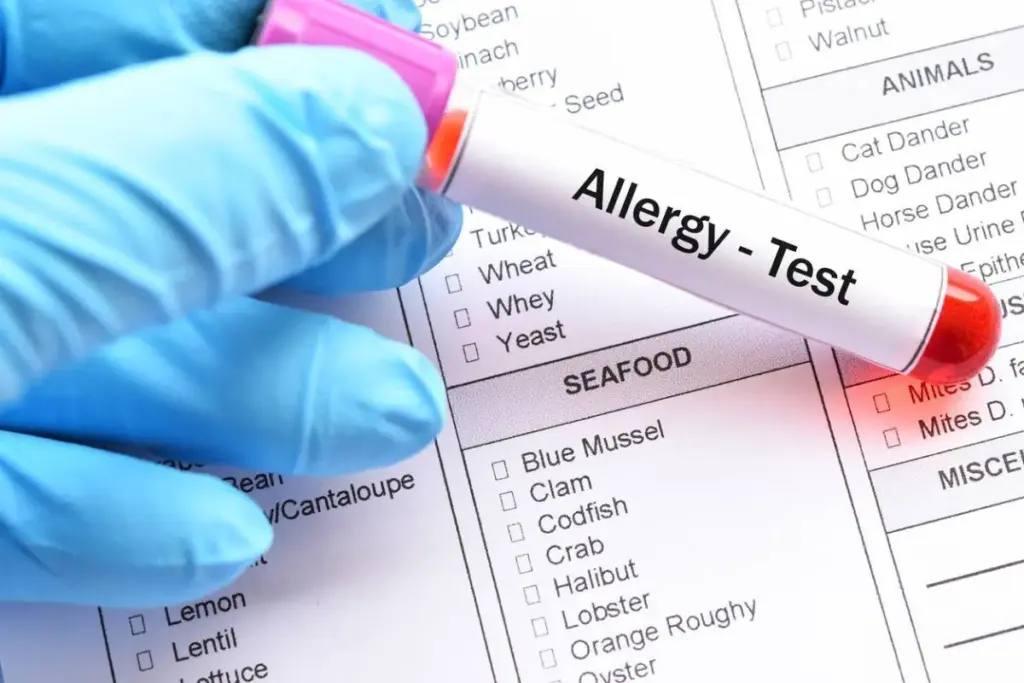 Complete What To Do Before Seeing An Allergist For Allergy Testing