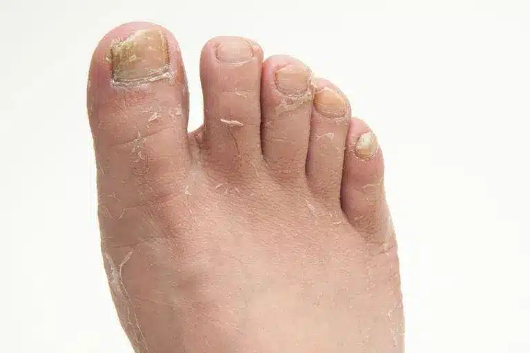 Guide Does Foot Fungus Smell (Athlete's Foot)?
