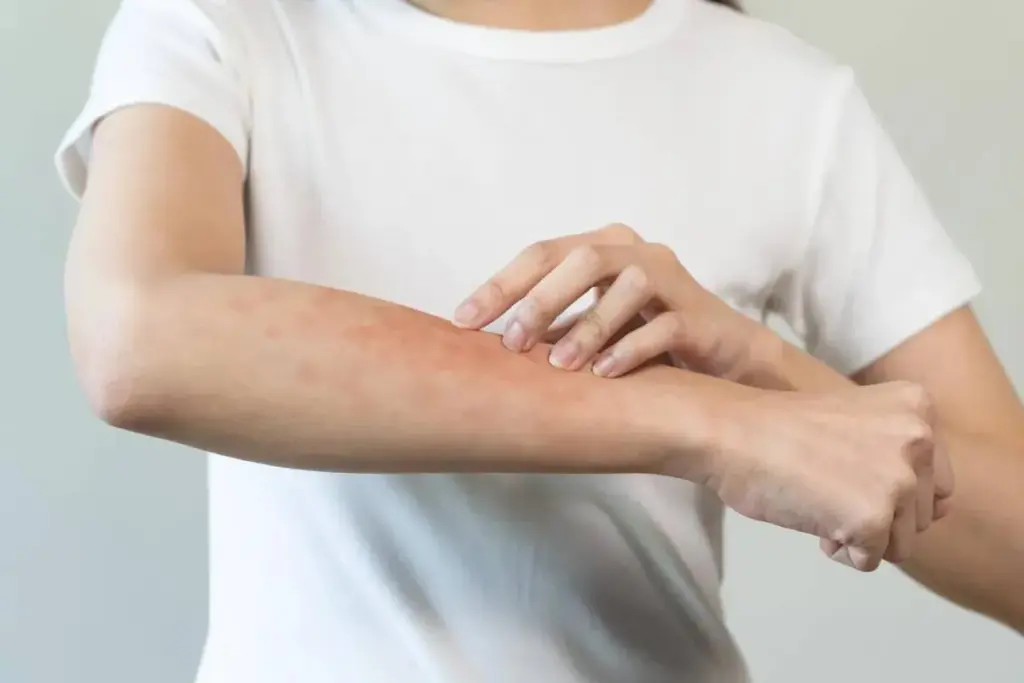 Simple How Uncomfortable Is Patch Testing (Patch Test Allergy)?