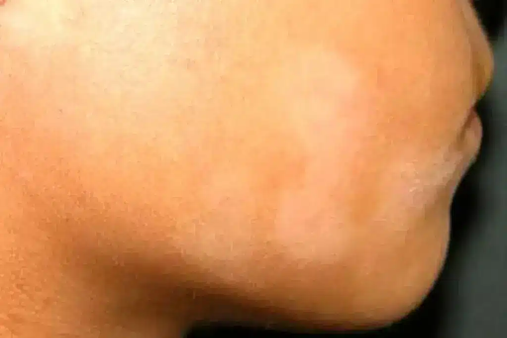 Insightful Understanding Tinea Versicolor And Its Impact