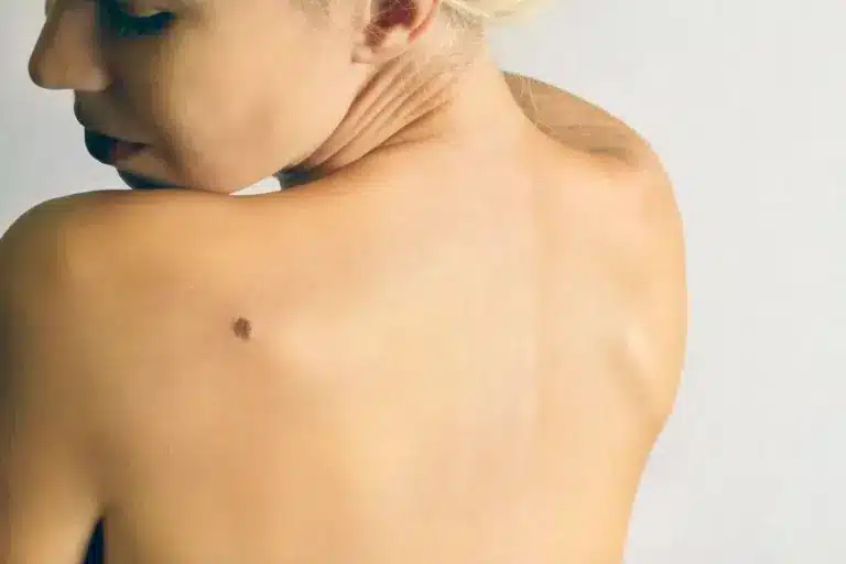 Fascinating Can A Wart Be Cancerous: How To Identify A Wart