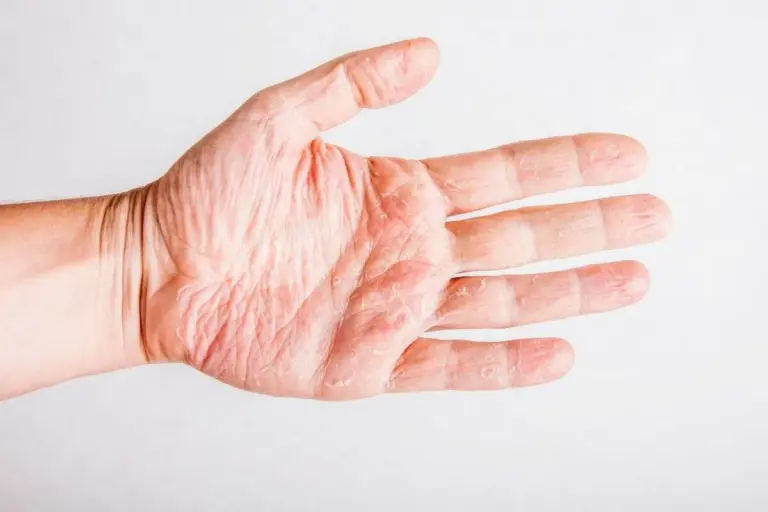 What Is Good For Eczema: Crucial Deficiency Link Fact