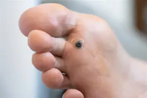 Sharp Is A Corn A Wart: Plantar Wart Vs Corn Differences