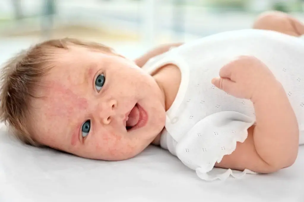 Baby Eczema: Crucial Powerful Treatment Tips for Parents