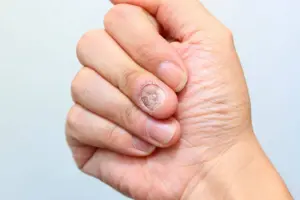 Crucial Guide To Fungal Infections: Tinea Versicolor