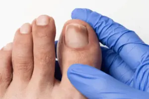 Amazing Onychomycosis: Understanding & Treatment Options