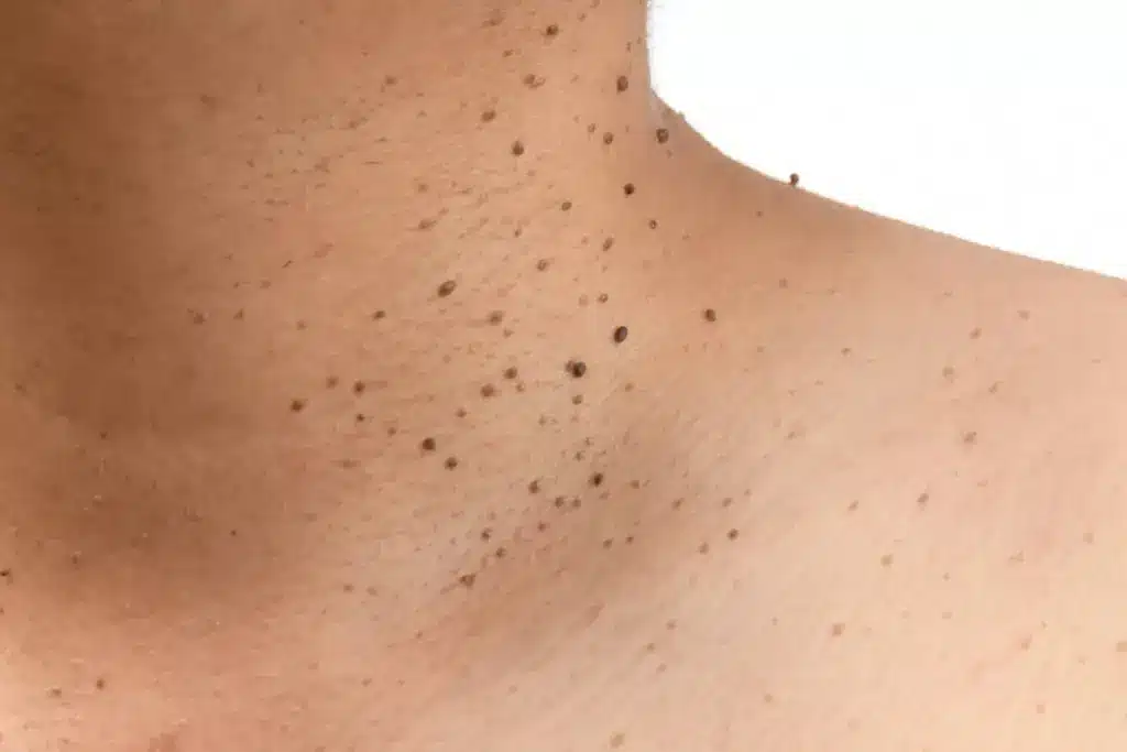 Amazing Are Most Moles Benign: Moles And Skin Safety 2 image 2 417 LIV Hospital