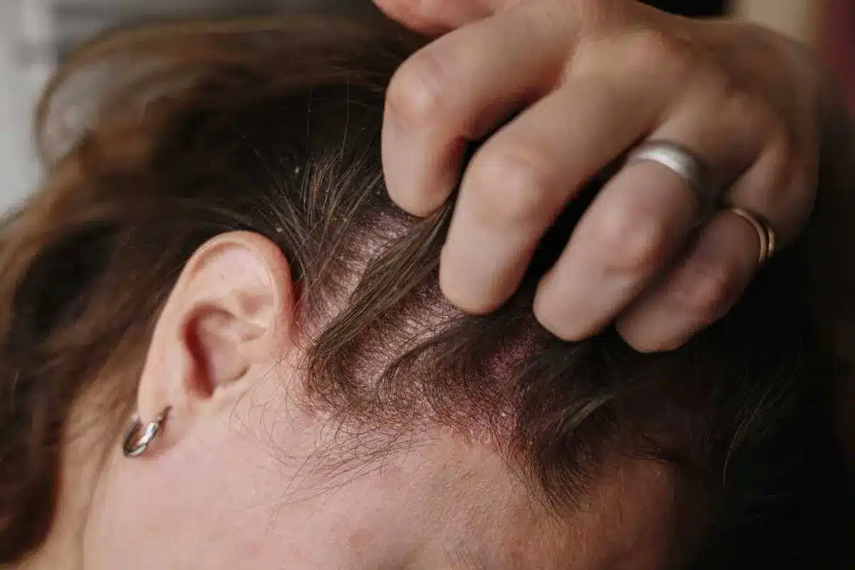 Can You Get Psoriasis Later In Life: Crucial Serious Sepsis Risk