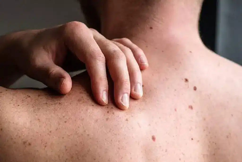 Fascinating How Painful Is A Skin Biopsy (Bypsee)?