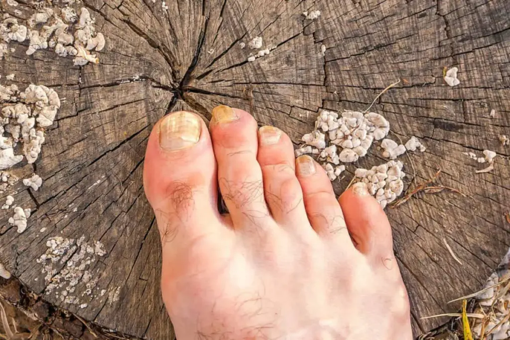 Valuable What Kills Toenail Fungus Instantly: Guide 1 Valuable What Kills Toenail Fungus Instantly: Guide