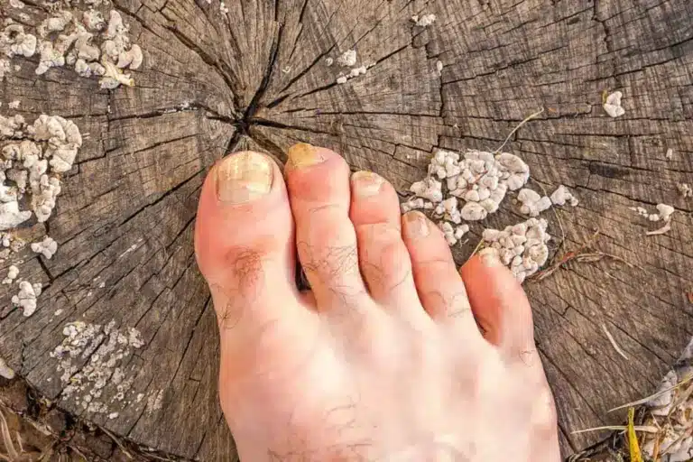 Valuable What Kills Toenail Fungus Instantly: Guide