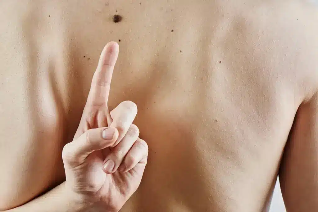 Guide What Age Does Melanoma Peak: Skin Cancer Statistics