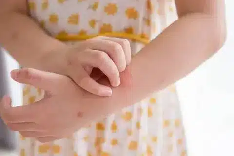 How To Cure Eczema Permanently: The Amazing Powerful Steps