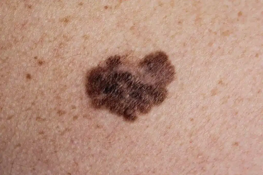 Complete What Kills Melanoma Cells Naturally (How To Treat Skin Cancer)?