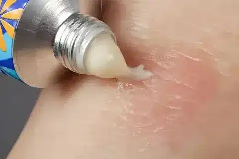 Dupixent: The Amazing Crucial Miracle Drug for Eczema