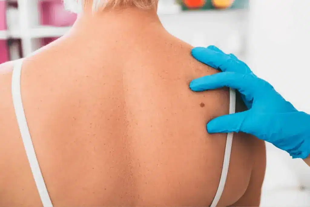 Crucial Does Getting A Mole Checked Hurt (With Images)? 1 Answering does getting a mole checked hurt (usually no) and explaining the quick, non-invasive process of examination.
