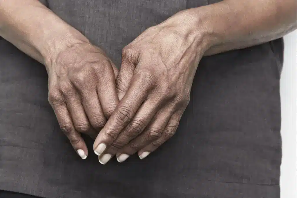 Blood Work To Test For Rheumatoid Arthritis: Crucial Psoriasis Link