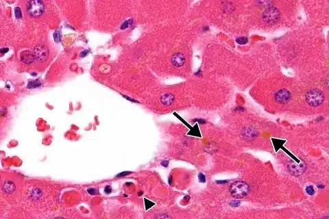 Ventricular Hypertrophy Life Expectancy: Crucial Survival Outlook