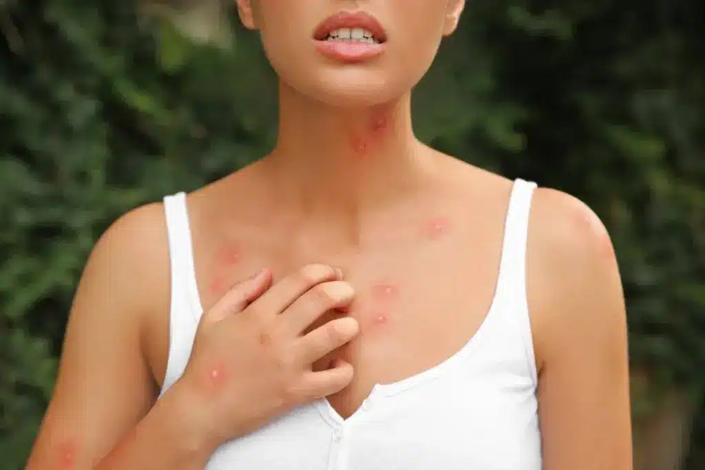 Simple Yeast Infection Treatment While Pregnant