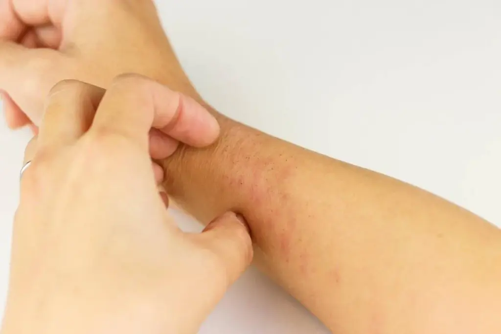 Valuable Fastest Way To Cure Urticaria: Antihistamine Hives Rash