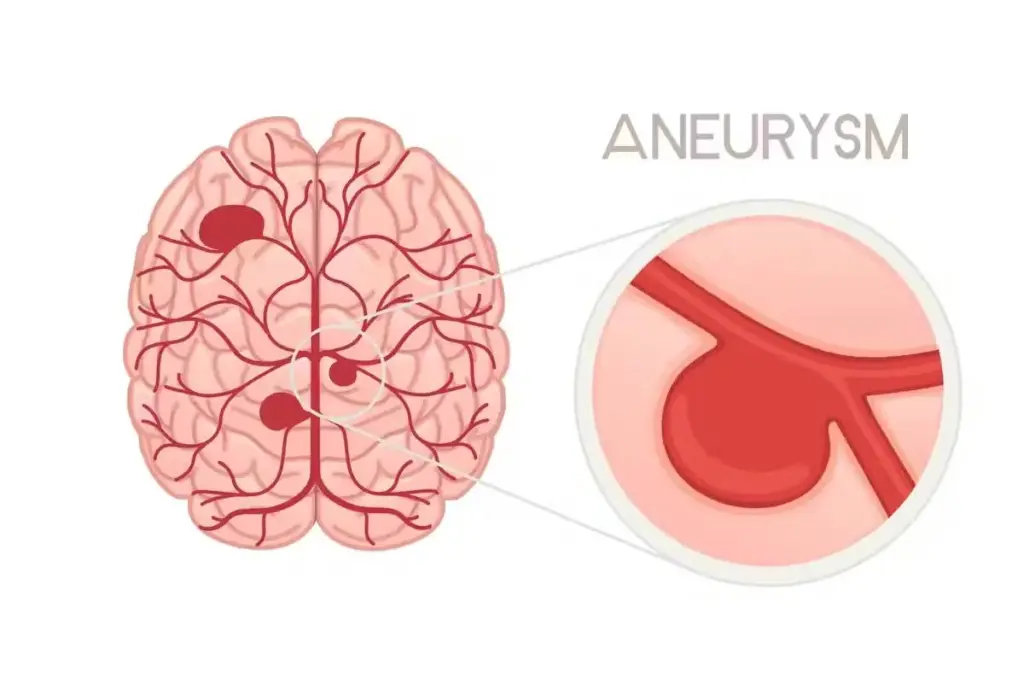 Can Stress Cause a Brain Aneurysm: The Serious Connection 3 Can Stress Cause a Brain Aneurysm: The Serious Connection