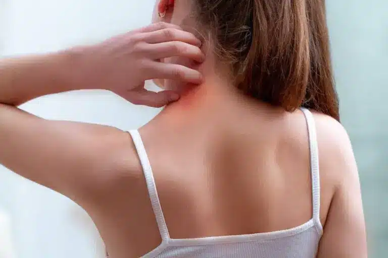 Guide Choosing Best Antihistamine Hives Rash