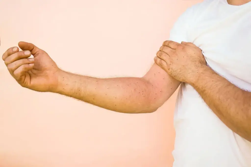 Complete Hives: Understanding Urticaria Symptoms 2 Complete Hives: Understanding Urticaria Symptoms