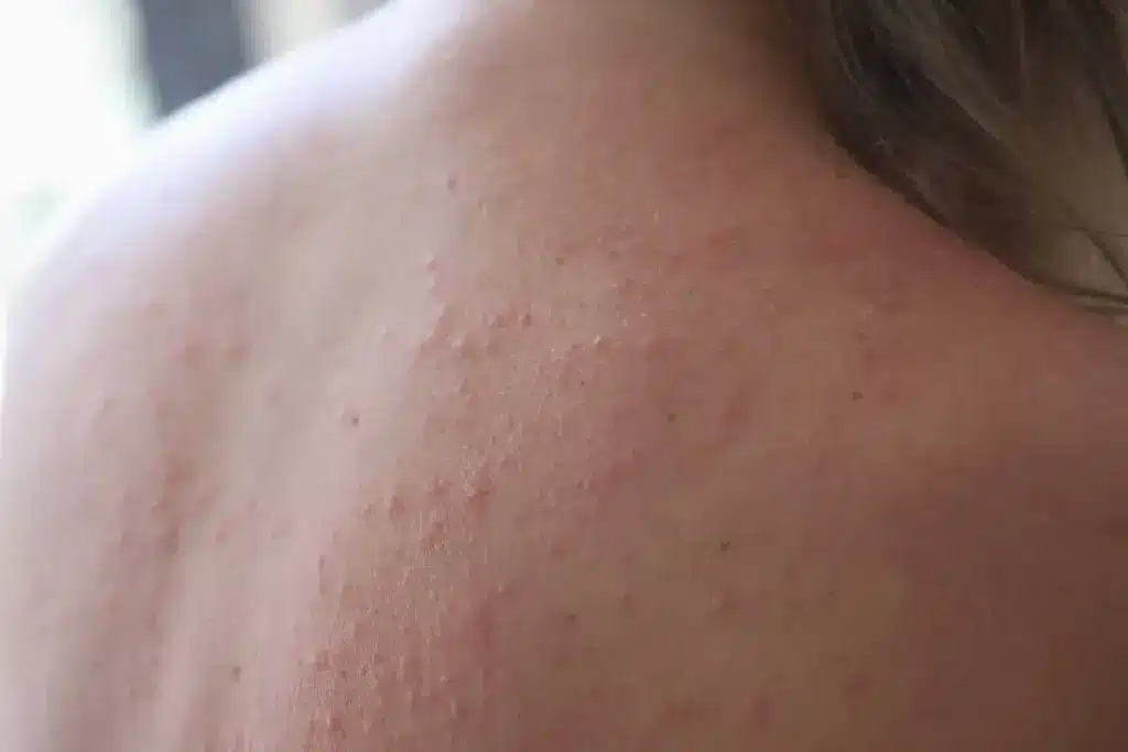 Amazing Itching All Over Body No Rash: Causes & Solutions