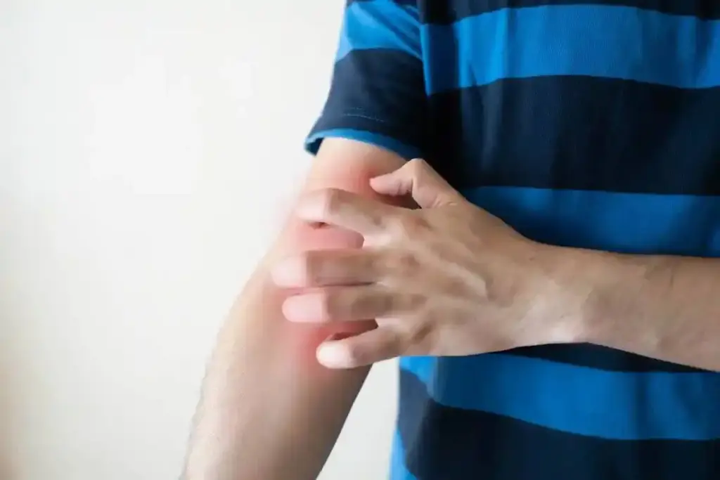 Crucial What Stops Itching Fast For Pruritus Relief?