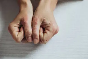 Psoriasis: Amazing Powerful Steps to Make It Go Away