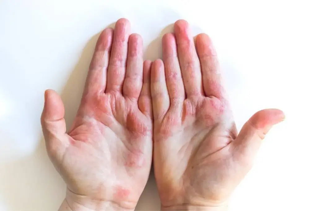 Eczema: Crucial Negative Things to Avoid Doing Now