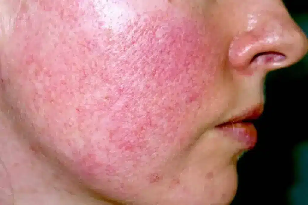 Natural Cure To Eczema: Amazing Best Oil for Relief Fact