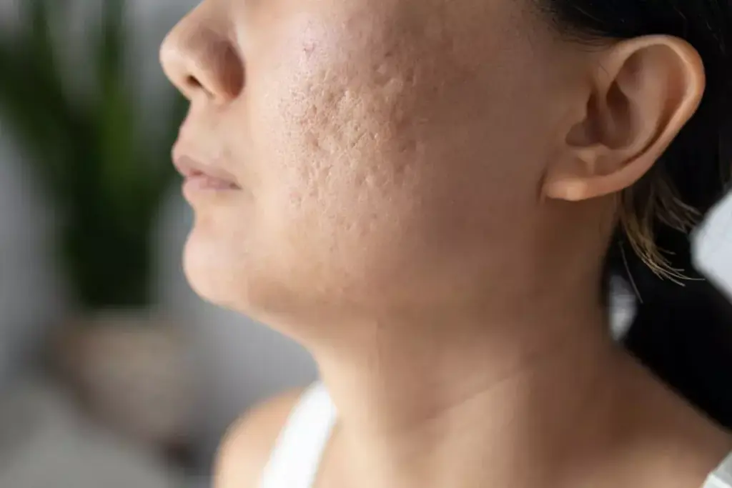 How to Get Rid of Acne Scars Naturally at Home