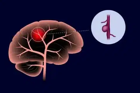 Aorta Rupture: Can Crucial Stress Cause This Serious Event?