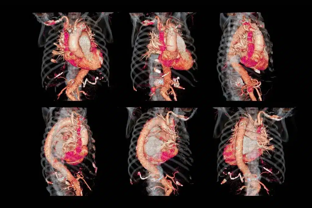 MRI Aortic Aneurysm: The Crucial Diagnostic Imaging Fact
