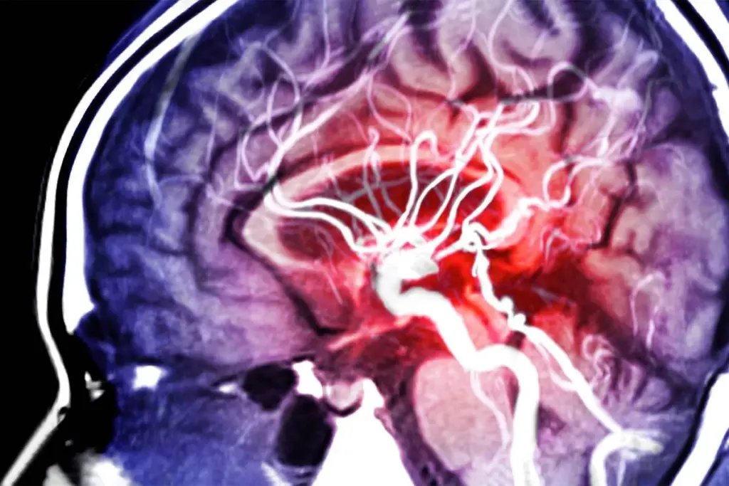 Hereditary Aortic Aneurysm: The Crucial Genetic Link Fact