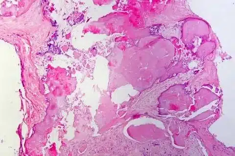 Aortic Aneurysm Rupture Signs: Emergency Symptoms 2 Aortic Aneurysm Rupture Signs: Emergency Symptoms