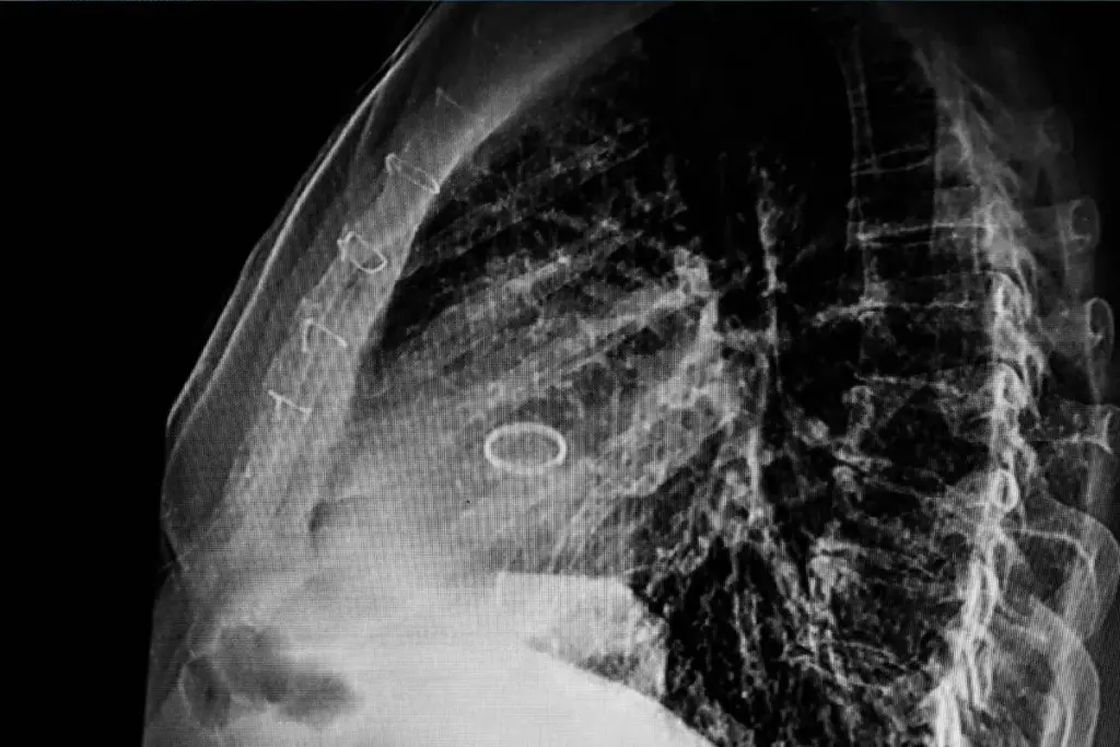 Deadly Heart Valve Disease: The Serious and Fatal Condition