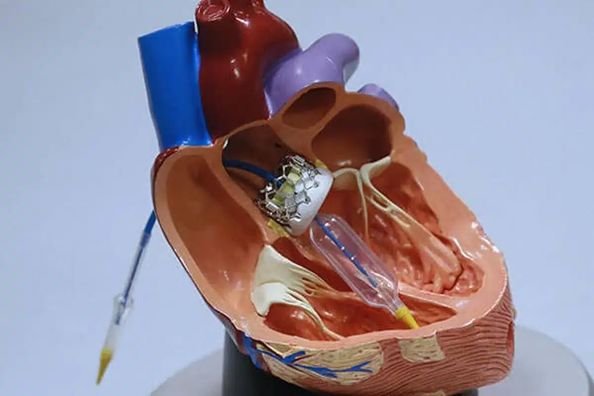 Mitral Valve Repair Pain: Excellent Management for Comfort Fact