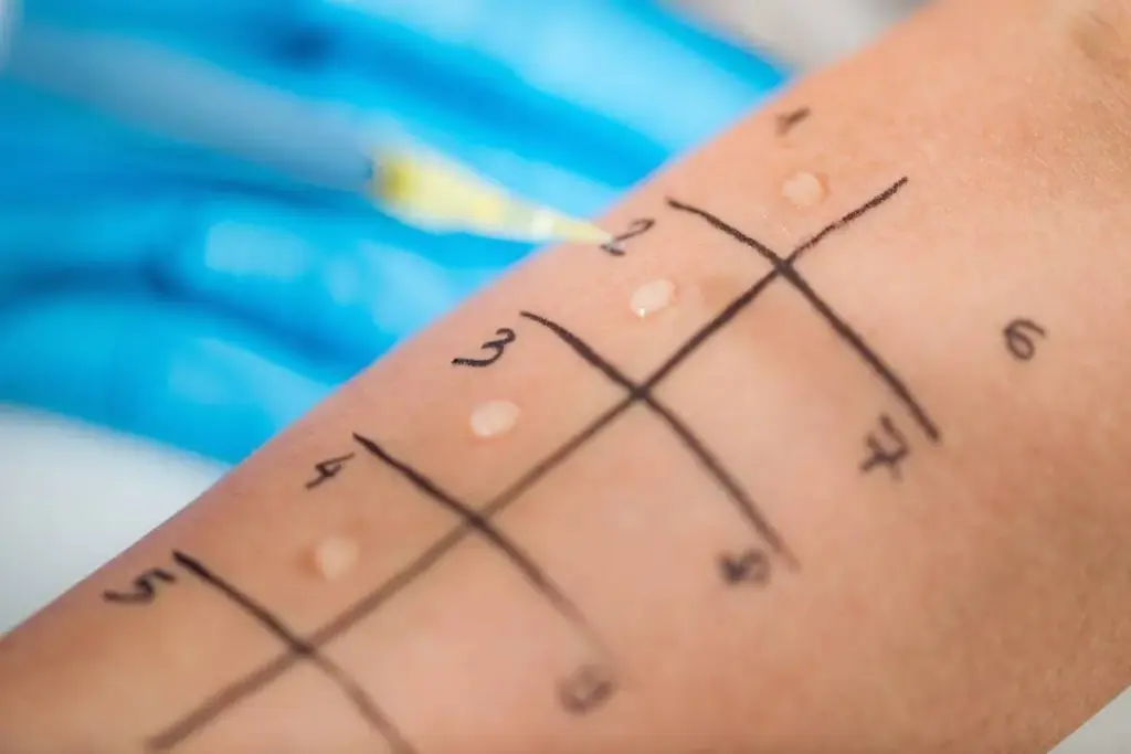 Essential How To Get An Allergy Test Without Insurance