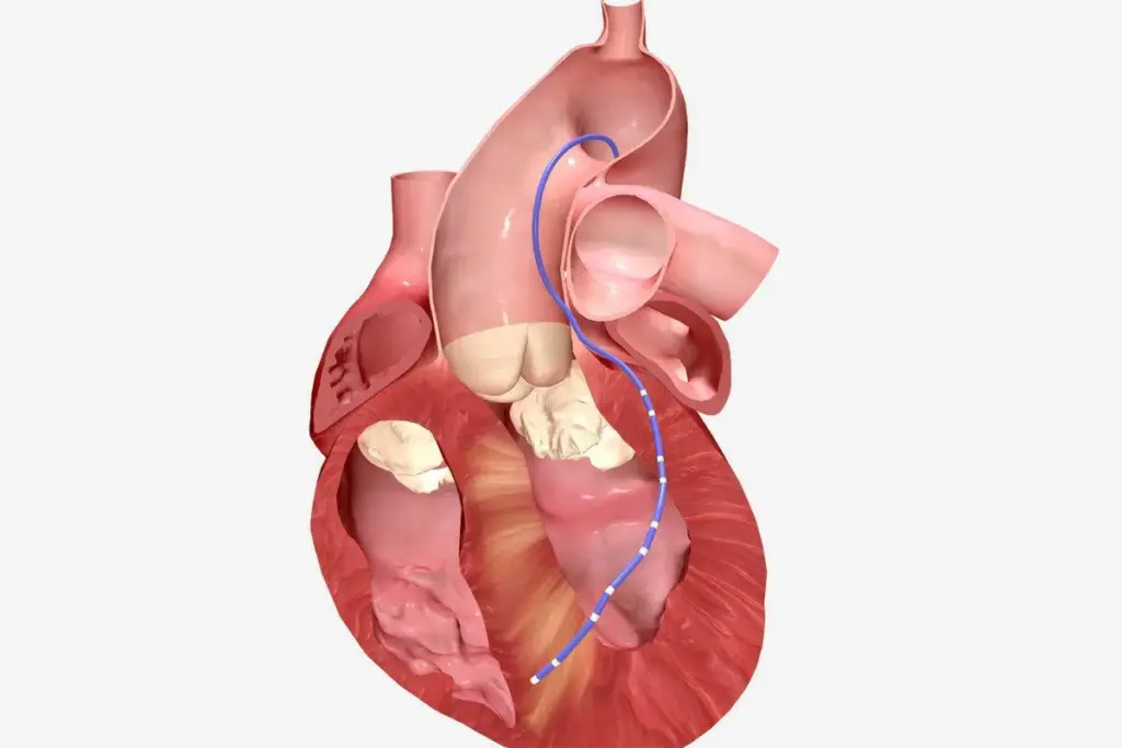 History Of Mitral Valve Repair: The Amazing Timeline Fact