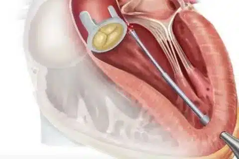 New Leaky Valve Treatment: Amazing Non-Surgical Options